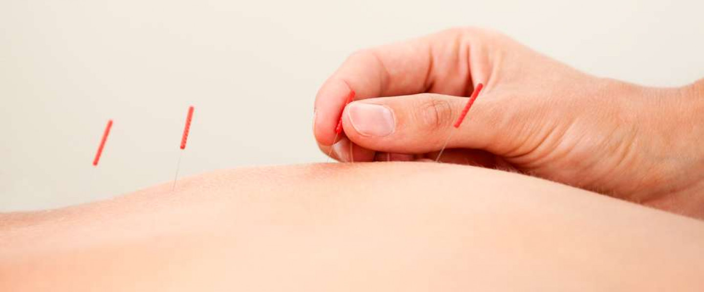 Did You Know We Do Dry Needling?